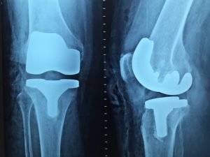 orthopedic pain